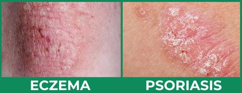 eczema vs psoriasis vörös foltok az ember lába között